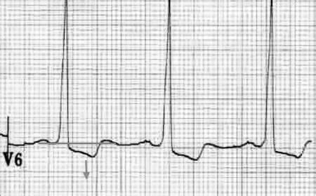 lv strain|my LVHN sign in.